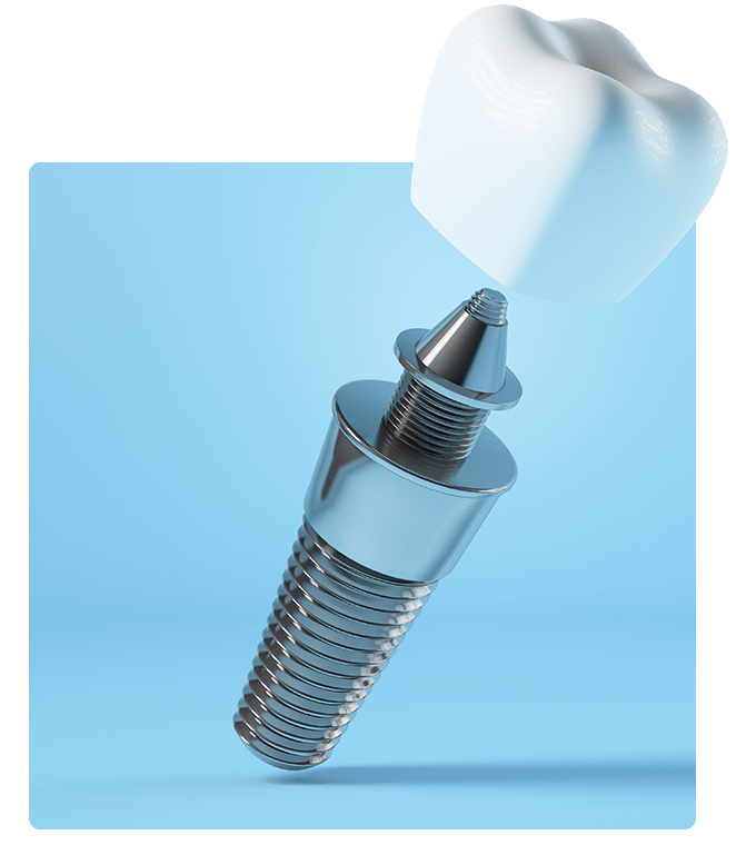 Tooth implant with permanent metal screw and dental crown