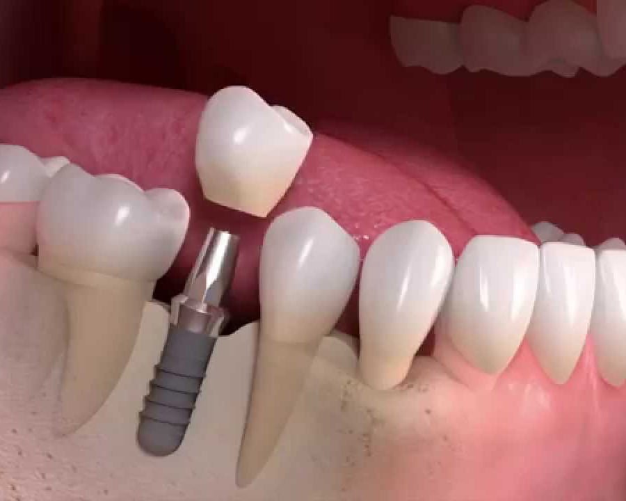 Close-up of dental implant abutment screw implant