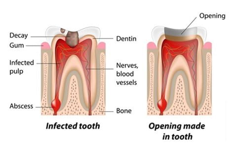 Dental Root Canal Treatment Step 1