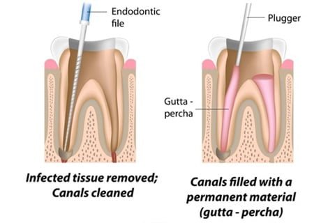 Dental Root Canal Treatment Step 2