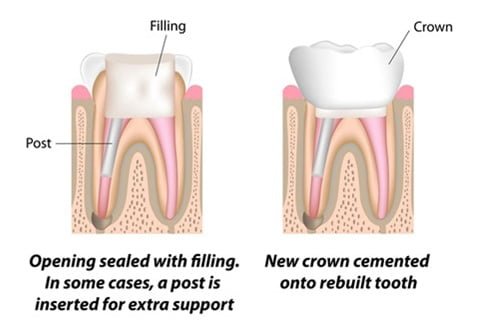 Dental Root Canal Treatment Step 3