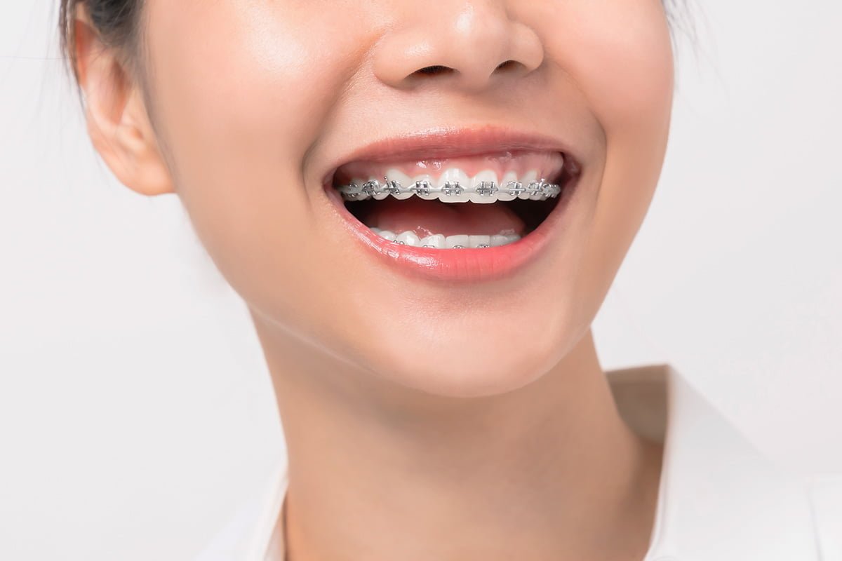 Orthodontic braces for achieving straighter teeth