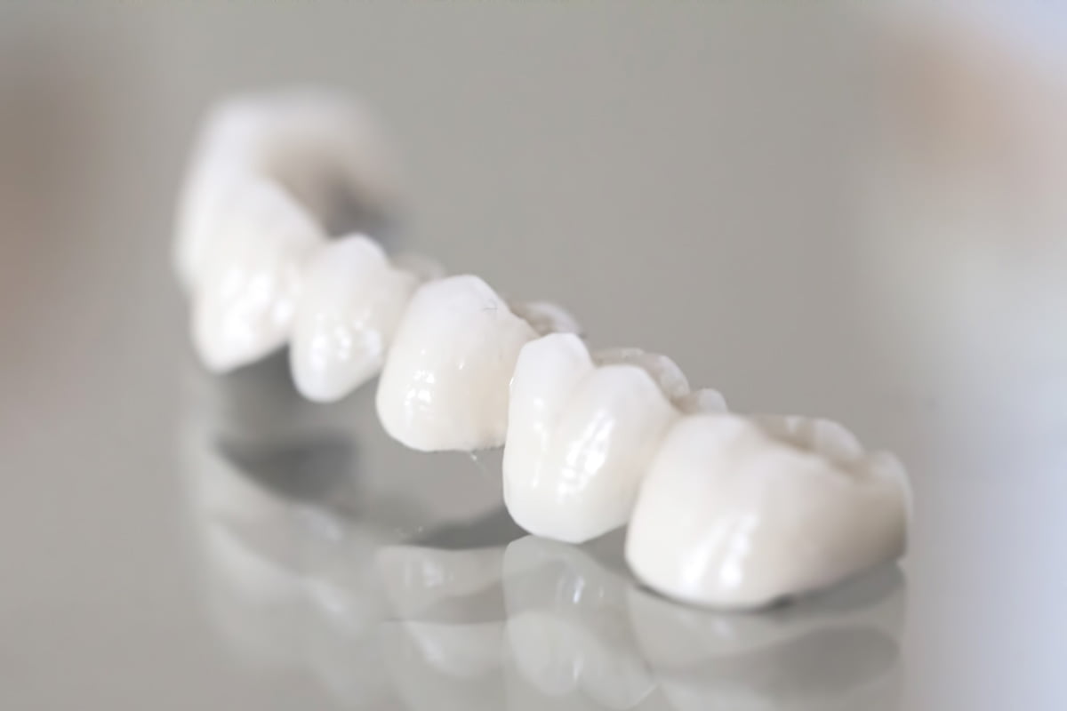 Dental Bridge in Real