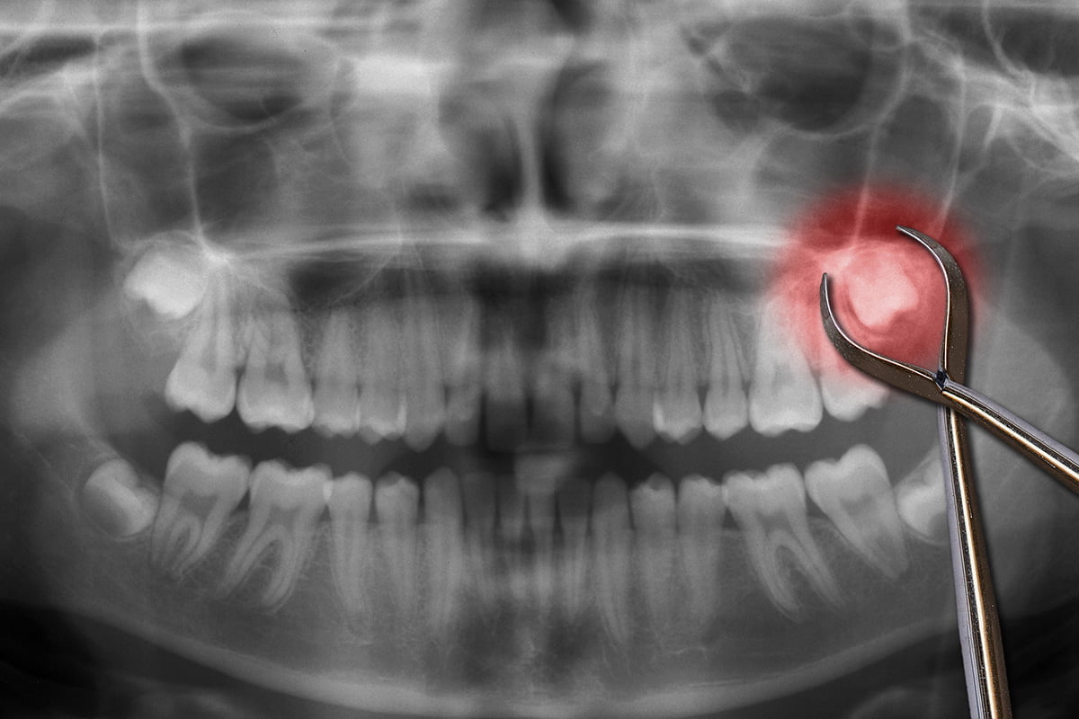 Panoramic image radiograph of teeth for wisdom tooth extraction