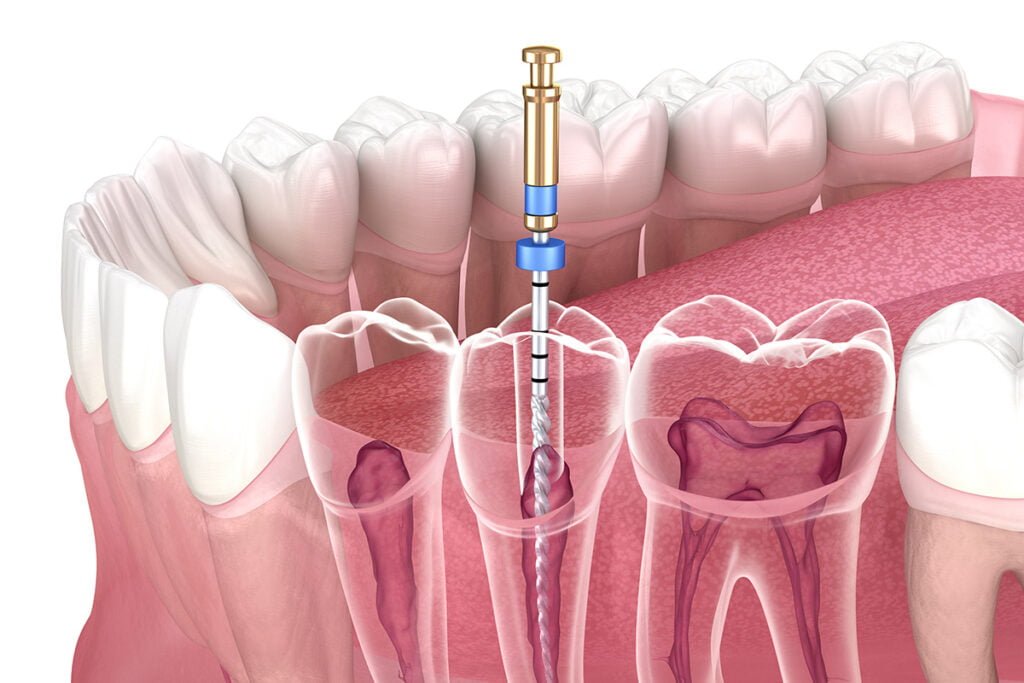 Root Canal Treatment Cost and Procedure KL Dental