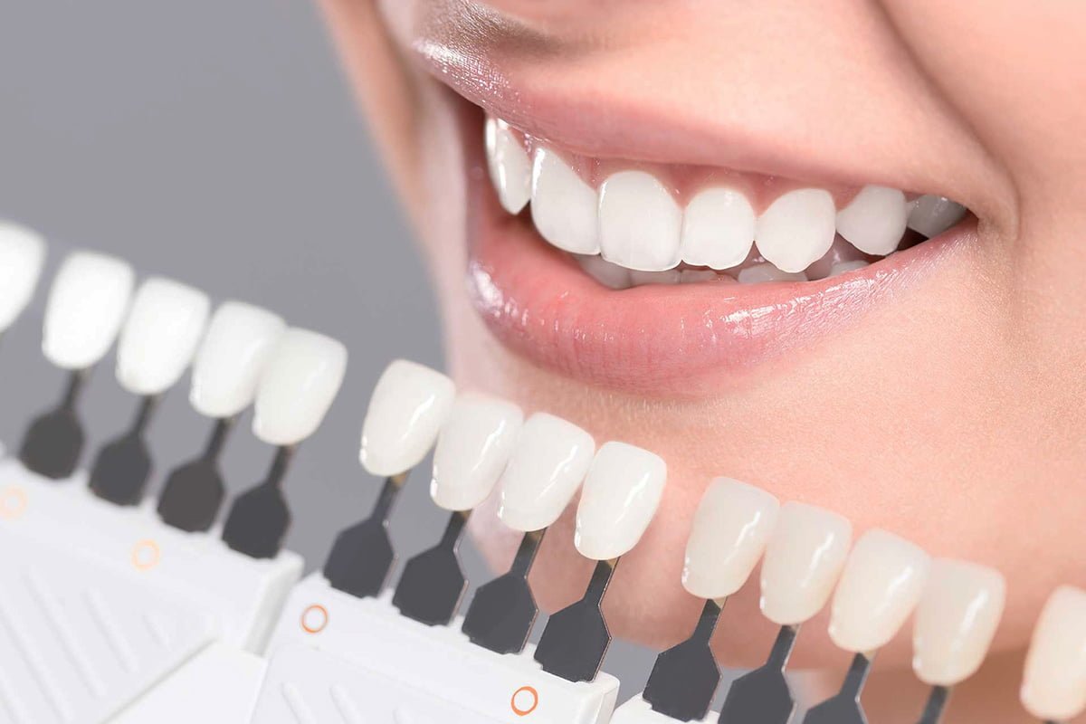Examining a patient with various veneer options featuring different teeth shades