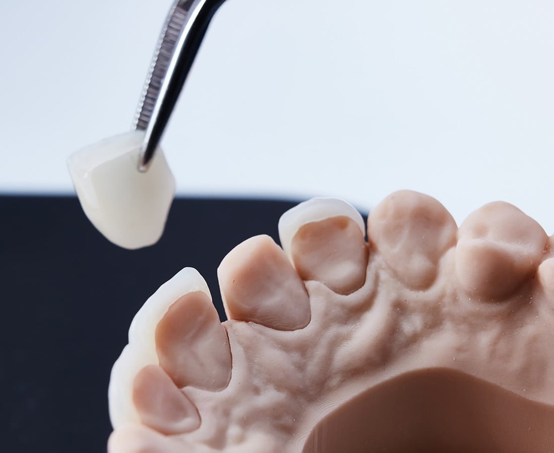 Dental Veneers