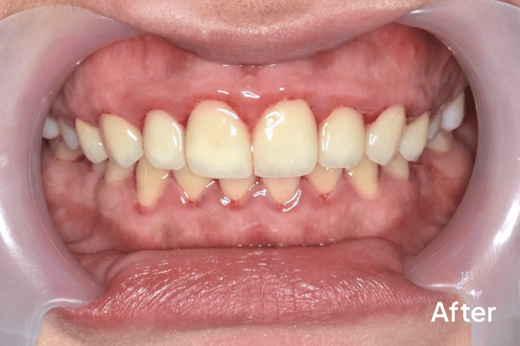 Veneers-after