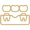 Dental bridge