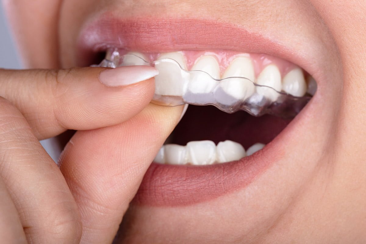 Orthodontic Invisalign Clear Braces