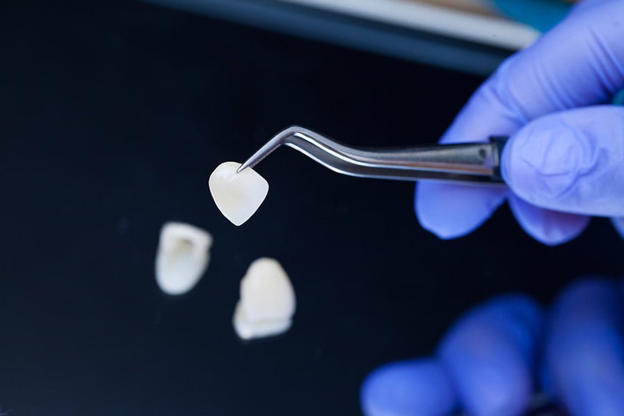 Veneers visit 2