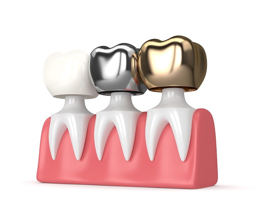 Different types of crown for teeth | Metal crown | Resin crown | Ceramic crown
