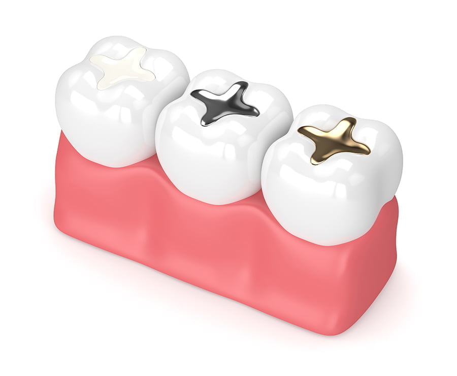 3D Dental Onlay Model