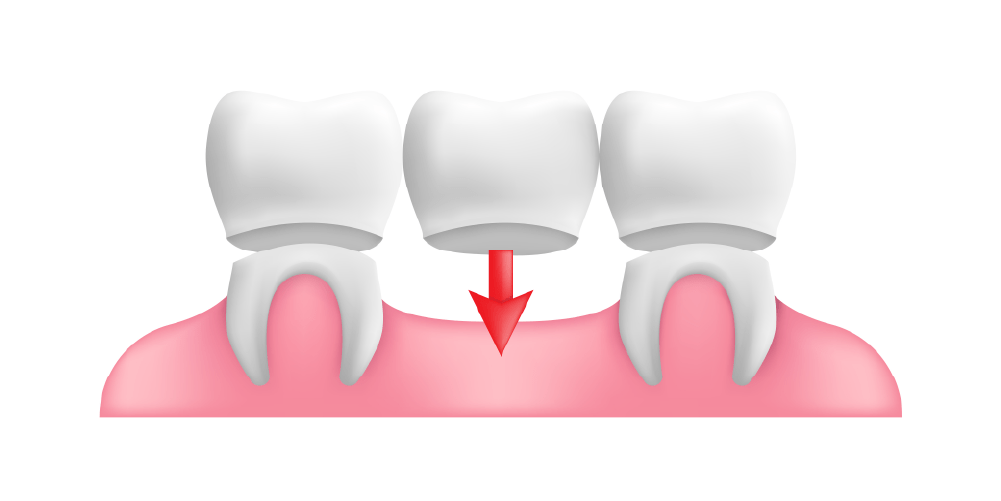 dental-bridge-3d