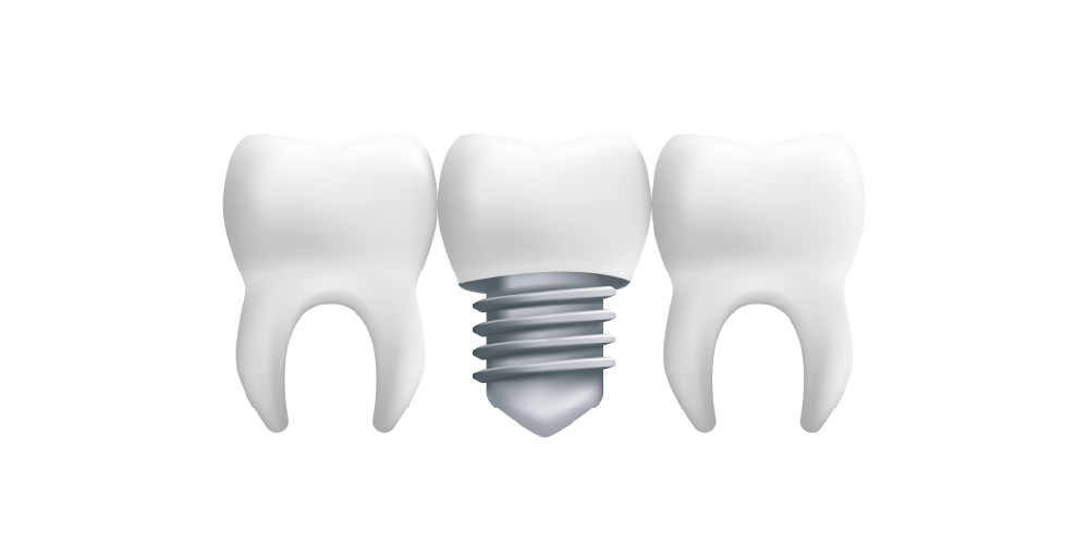 dental-implant-3d A close-up image of a titanium dental implant post inserted into the jawbone, prepared for the placement of a crown.